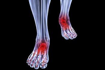 Arthritic foot and ankle care treatment in the Ventura County, CA: Camarillo (Oxnard, Thousand Oaks, Ventura, Santa Paula), Los Angeles County: Los Angeles (Santa Clarita, Glendale, Pasadena, Burbank, Santa Monica) areas