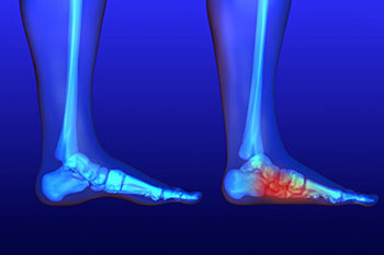 Flat Feet and Fallen Arches Treatment in the Ventura County, CA: Camarillo (Oxnard, Thousand Oaks, Ventura, Santa Paula), Los Angeles County: Los Angeles (Santa Clarita, Glendale, Pasadena, Burbank, Santa Monica) areas