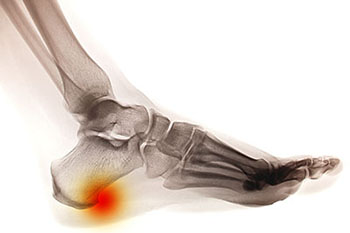 Heel spurs specialist in the Ventura County, CA: Camarillo (Oxnard, Thousand Oaks, Ventura, Santa Paula), Los Angeles County: Los Angeles (Santa Clarita, Glendale, Pasadena, Burbank, Santa Monica) areas