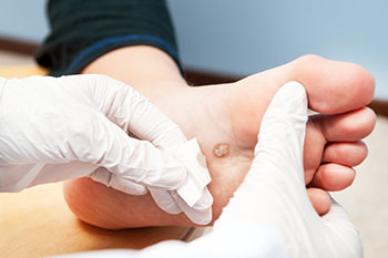 Plantar Warts Care & Treatment in the Ventura County, CA: Camarillo (Oxnard, Thousand Oaks, Ventura, Santa Paula), Los Angeles County: Los Angeles (Santa Clarita, Glendale, Pasadena, Burbank, Santa Monica) areas